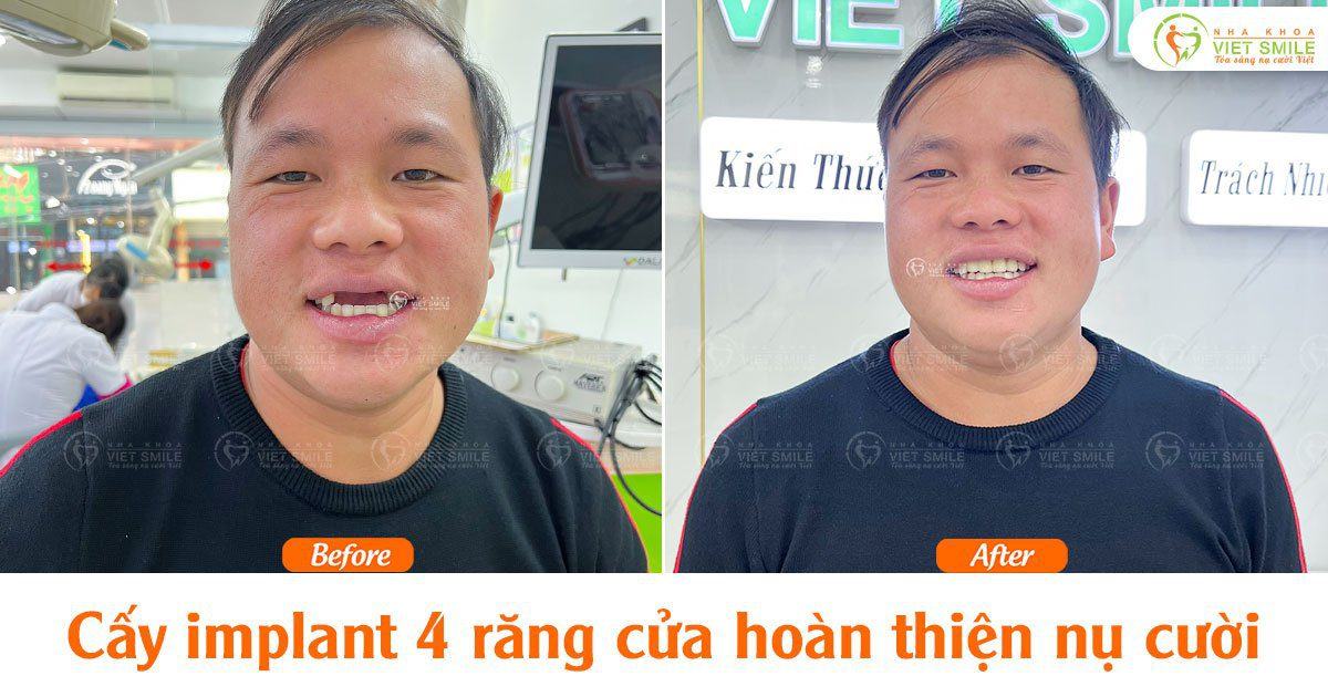 VietSmile Trị Cười Hở Lợi