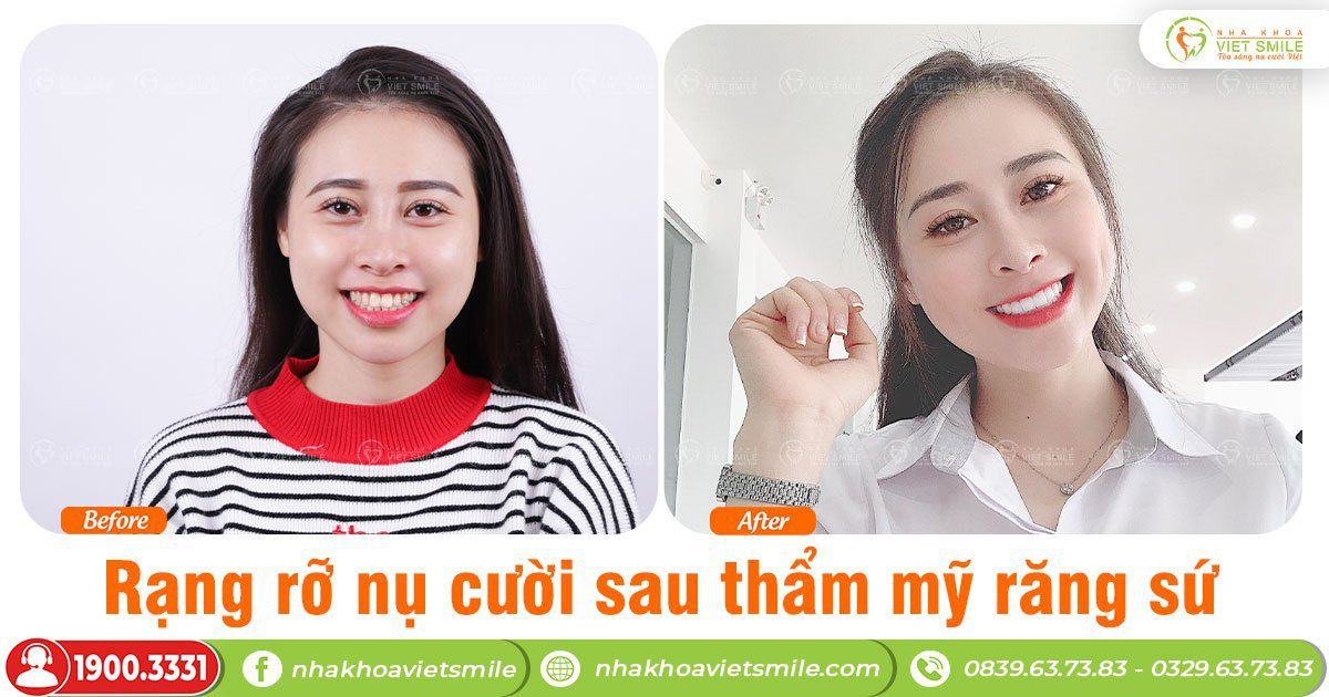 VietSmile Trị Cười Hở Lợi