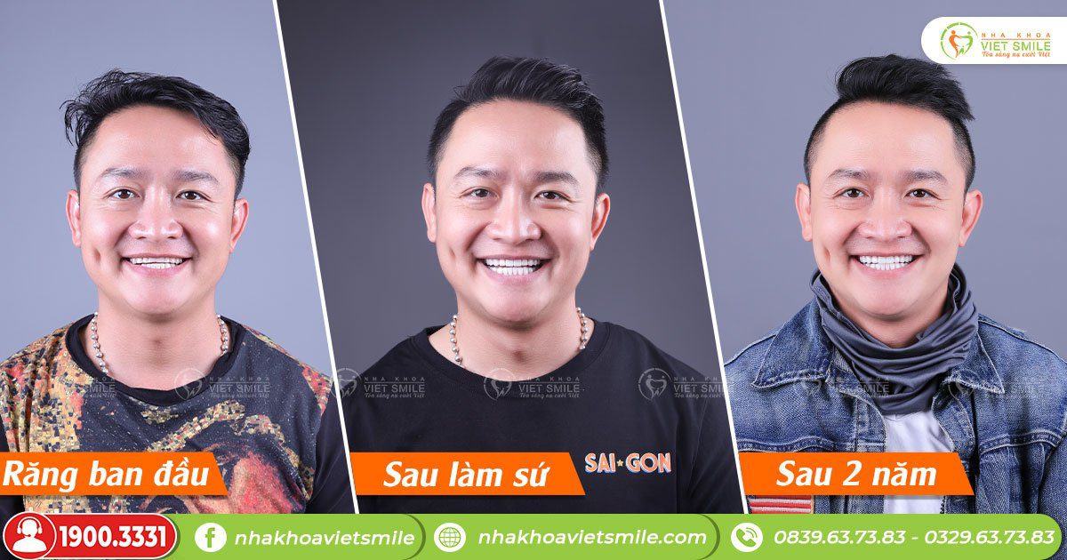 VietSmile Trị Cười Hở Lợi