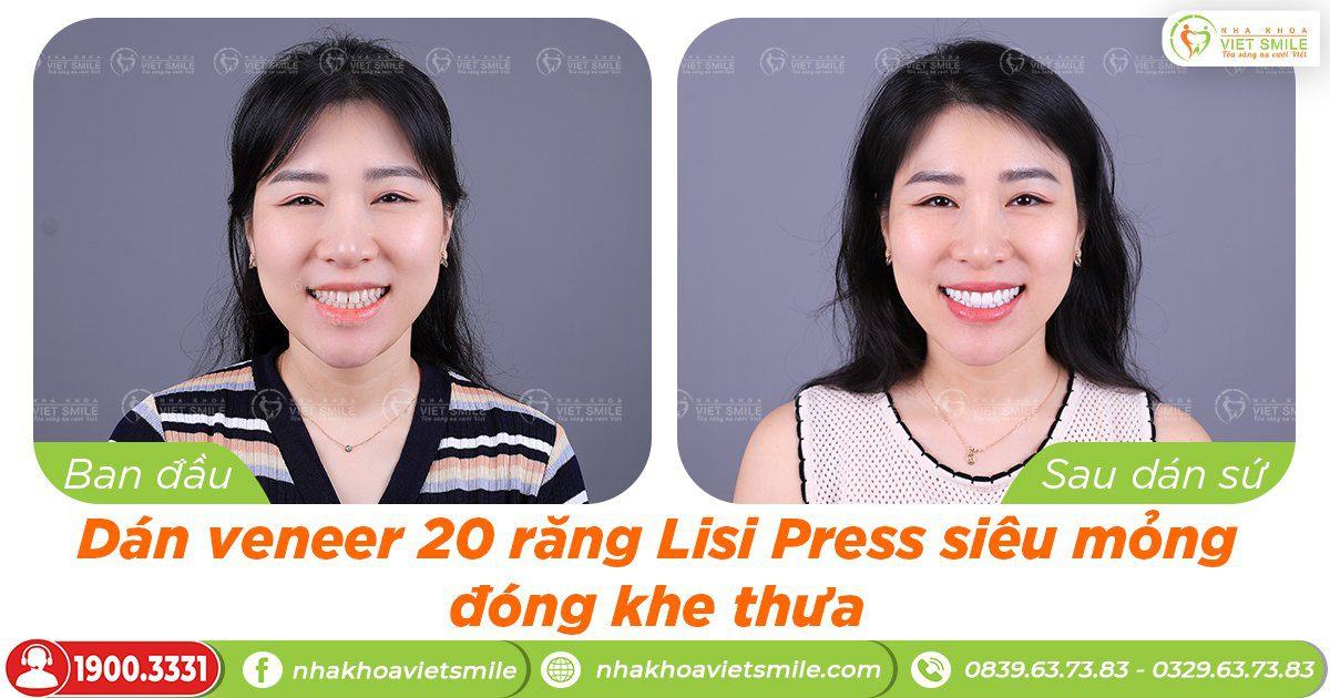 VietSmile Trị Cười Hở Lợi