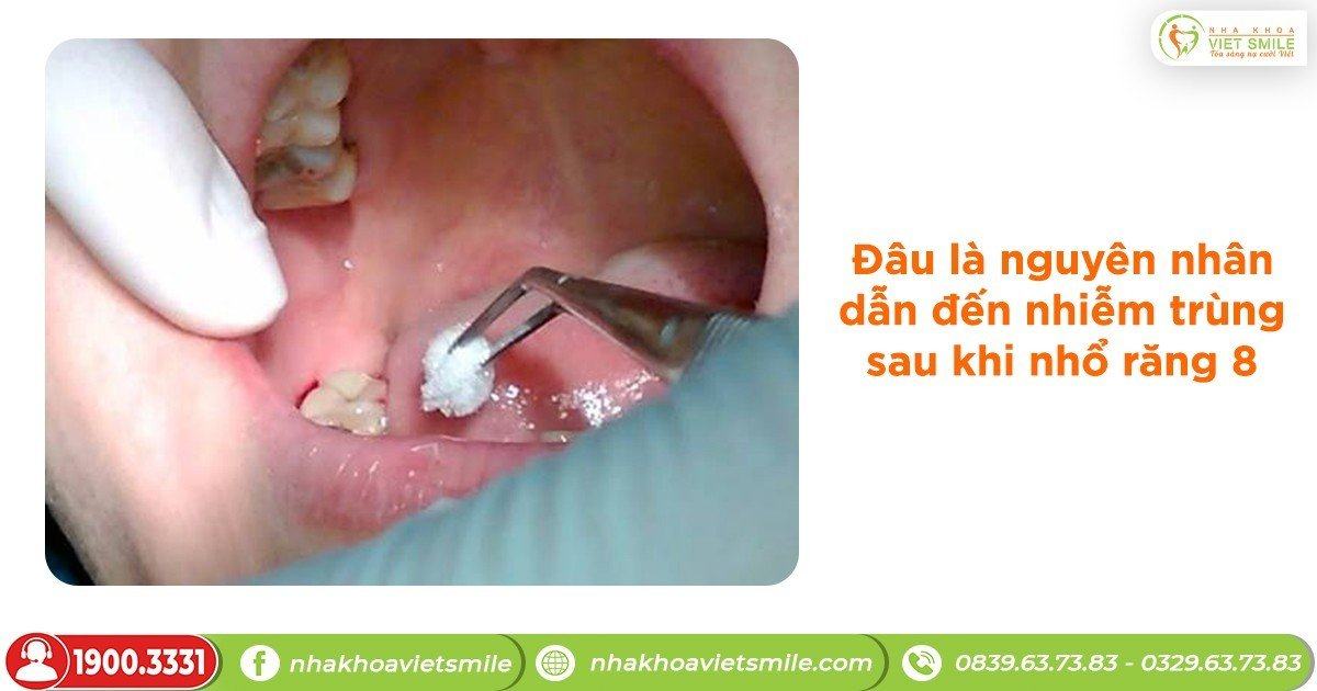 Đâu là nguyên nhân dẫn đến nhiễm trùng sau khi nhổ răng 8?