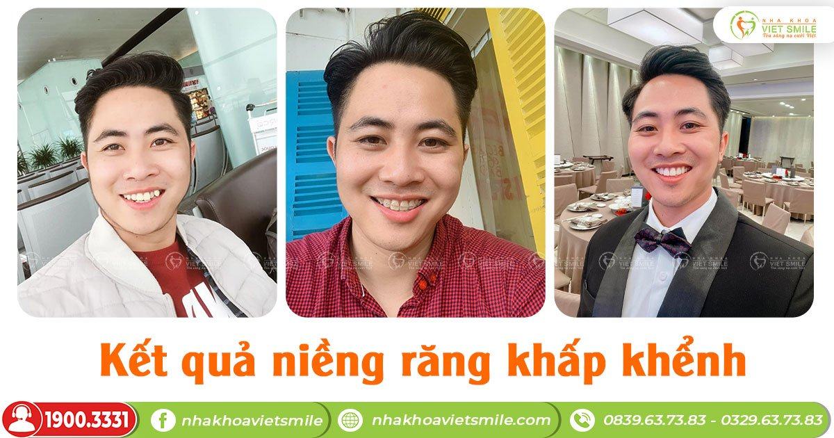 VietSmile Trị Cười Hở Lợi