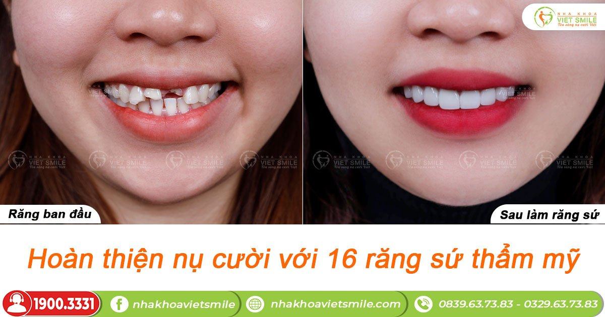 VietSmile Trị Cười Hở Lợi