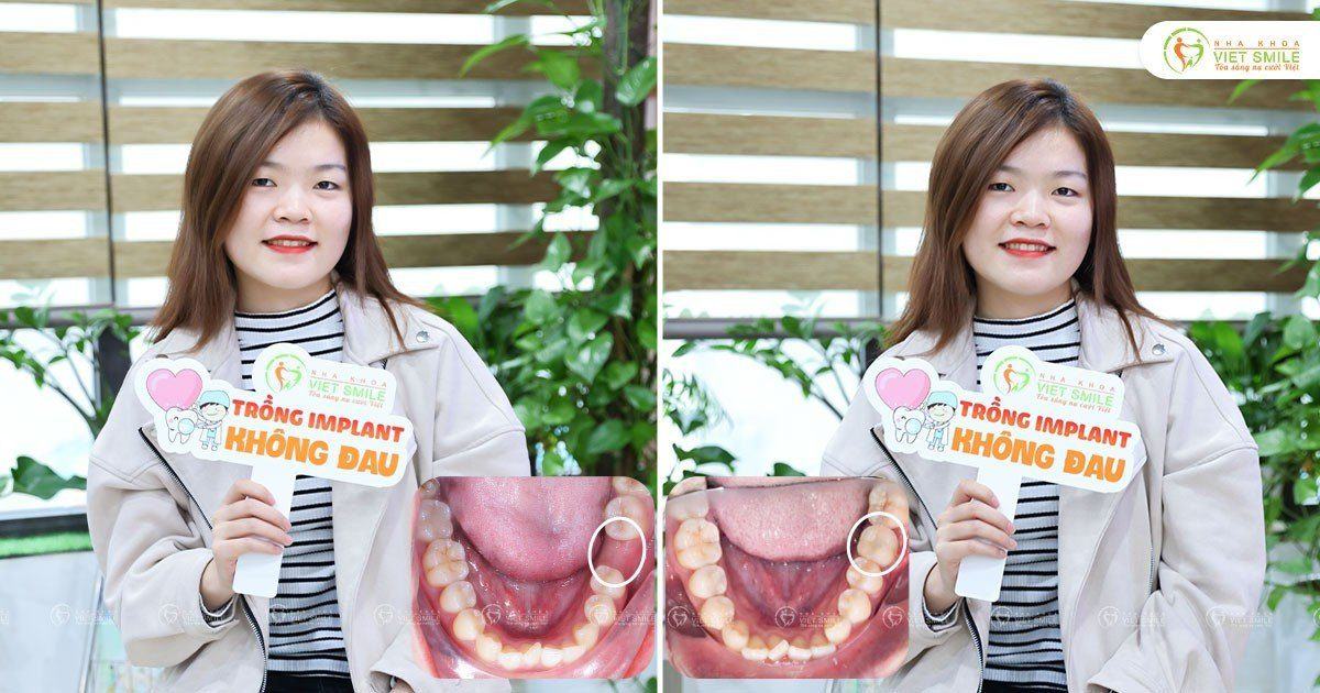 VietSmile Trị Cười Hở Lợi