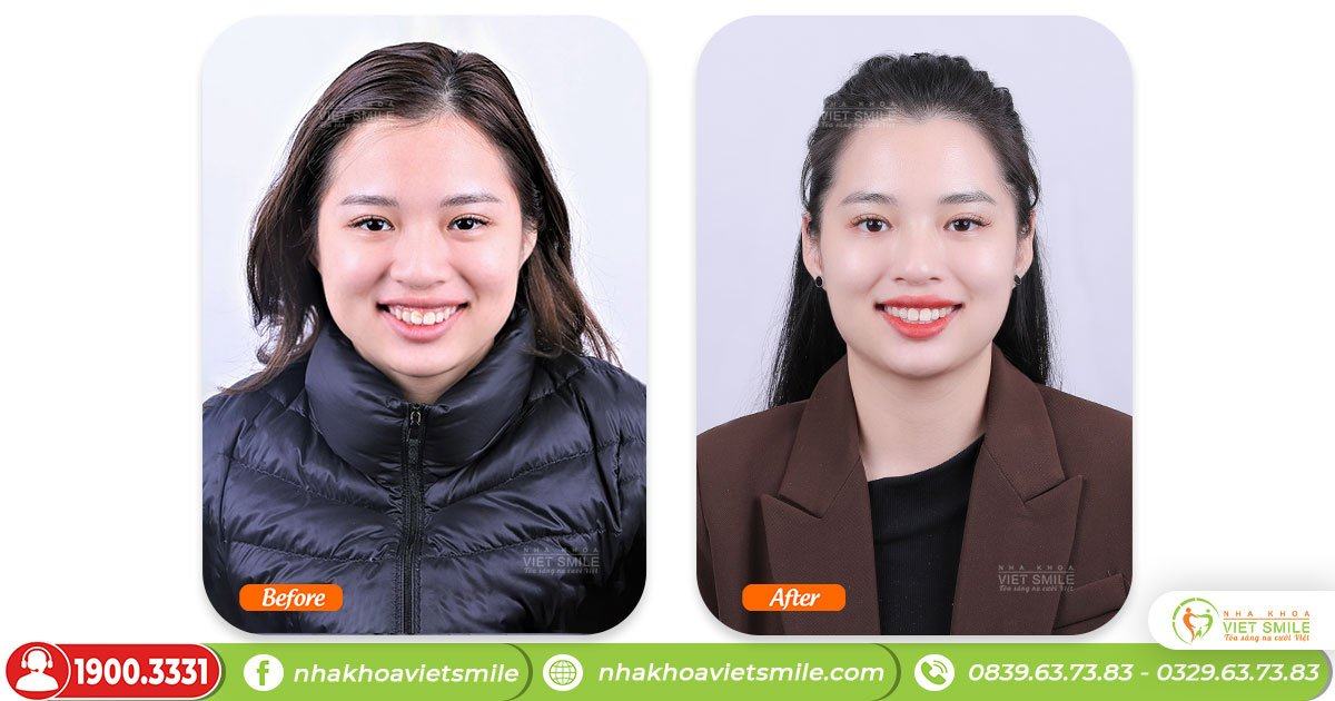 VietSmile Trị Cười Hở Lợi