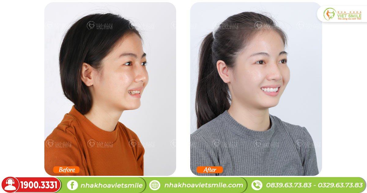 VietSmile Trị Cười Hở Lợi