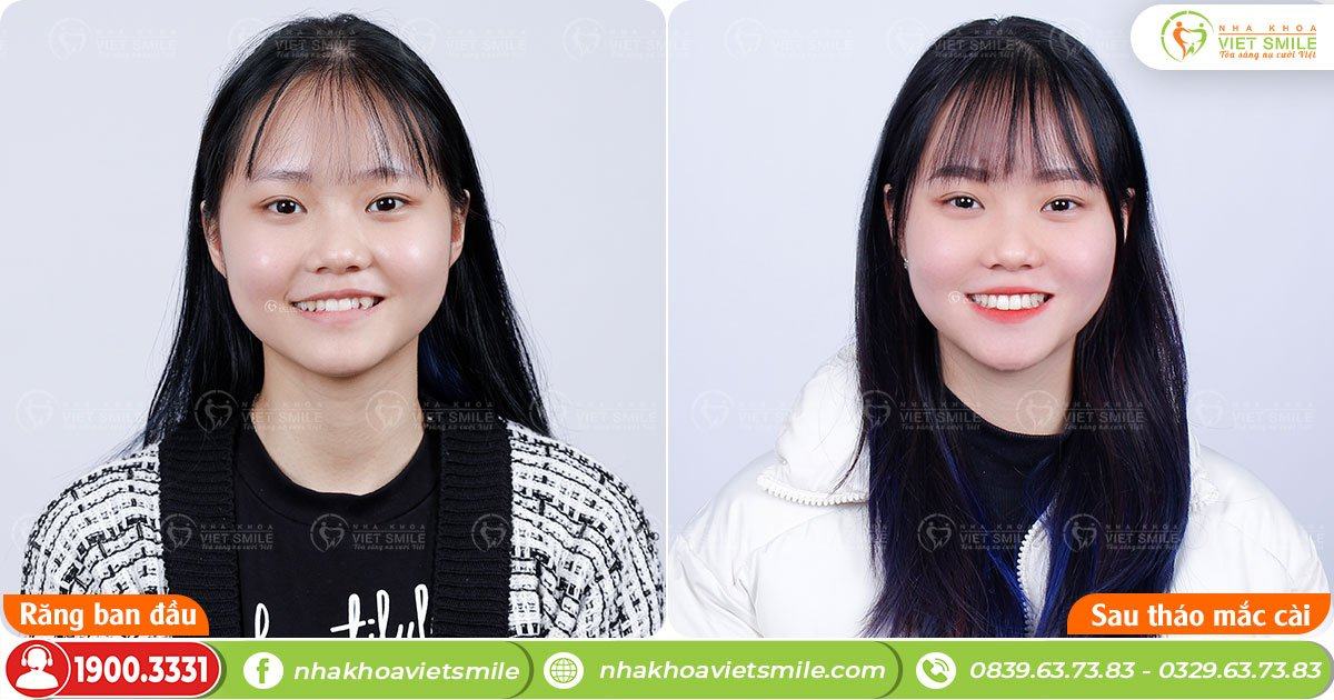 VietSmile Trị Cười Hở Lợi