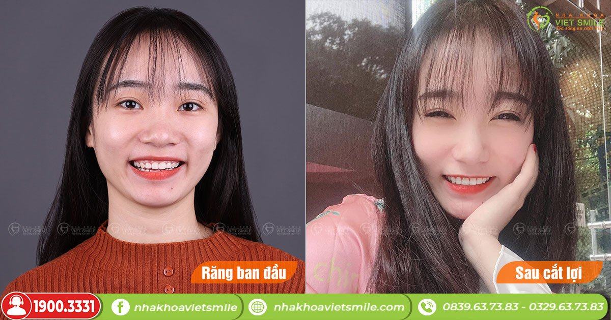 VietSmile Trị Cười Hở Lợi