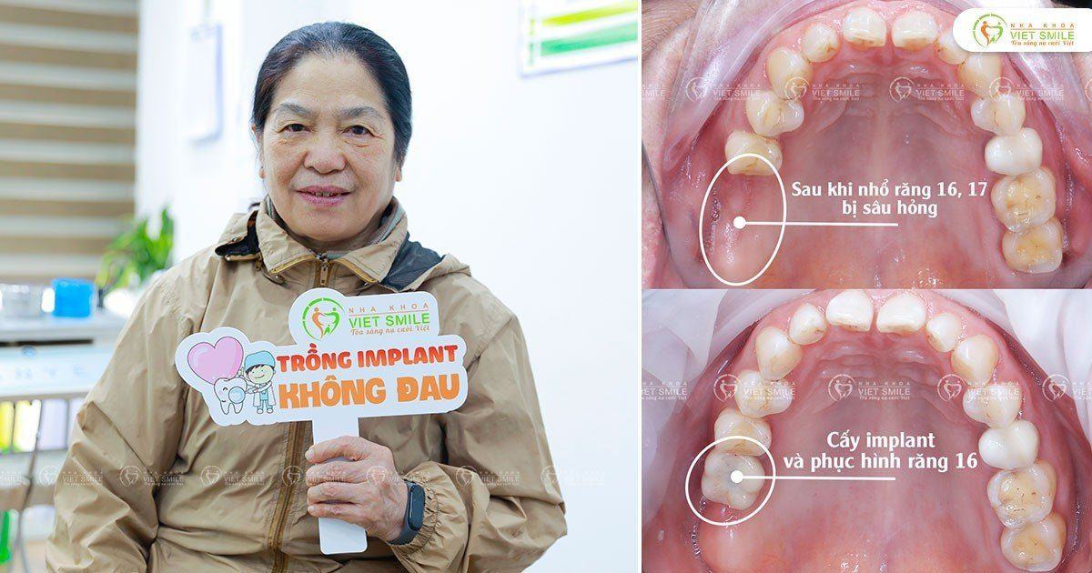 VietSmile Trị Cười Hở Lợi