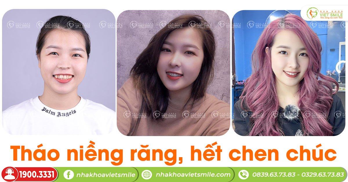 VietSmile Trị Cười Hở Lợi