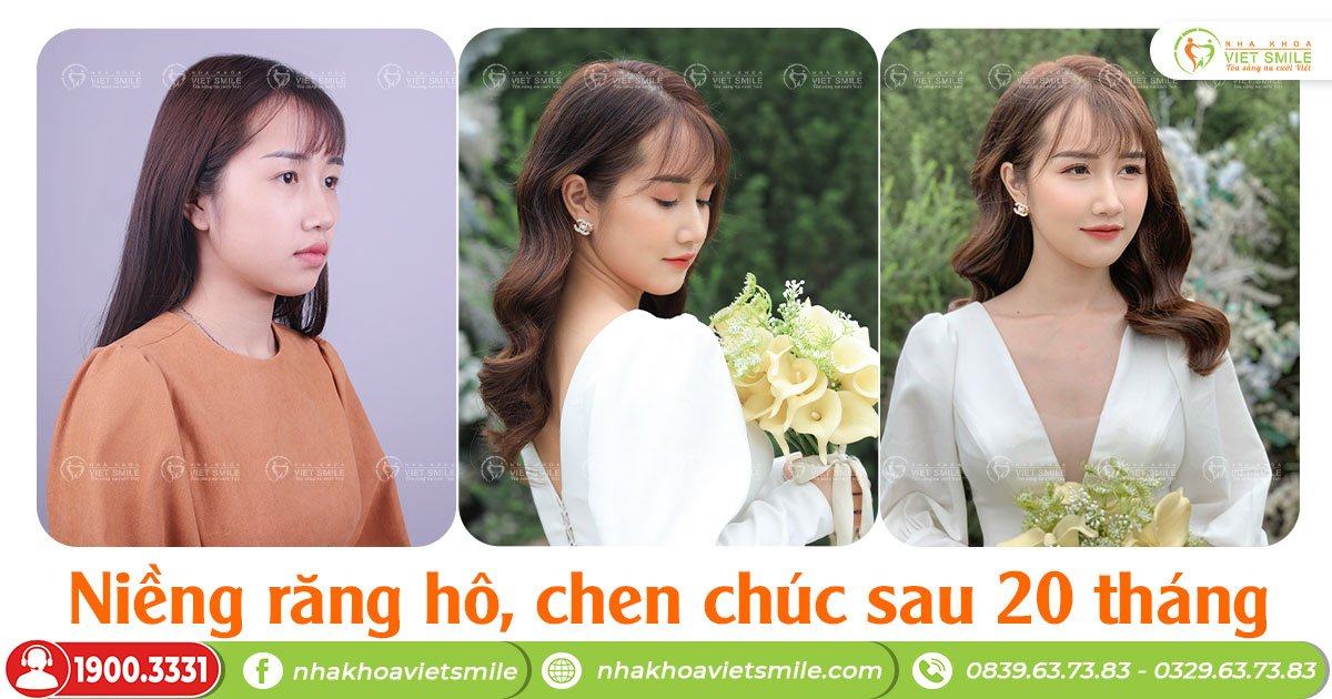 VietSmile Trị Cười Hở Lợi