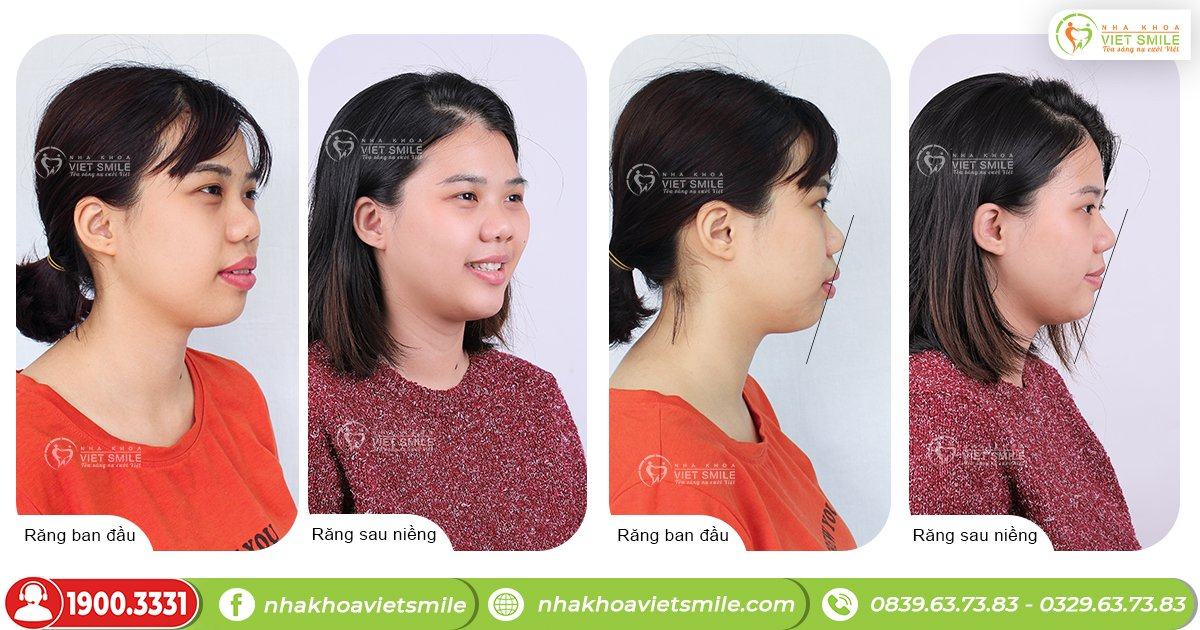 VietSmile Trị Cười Hở Lợi