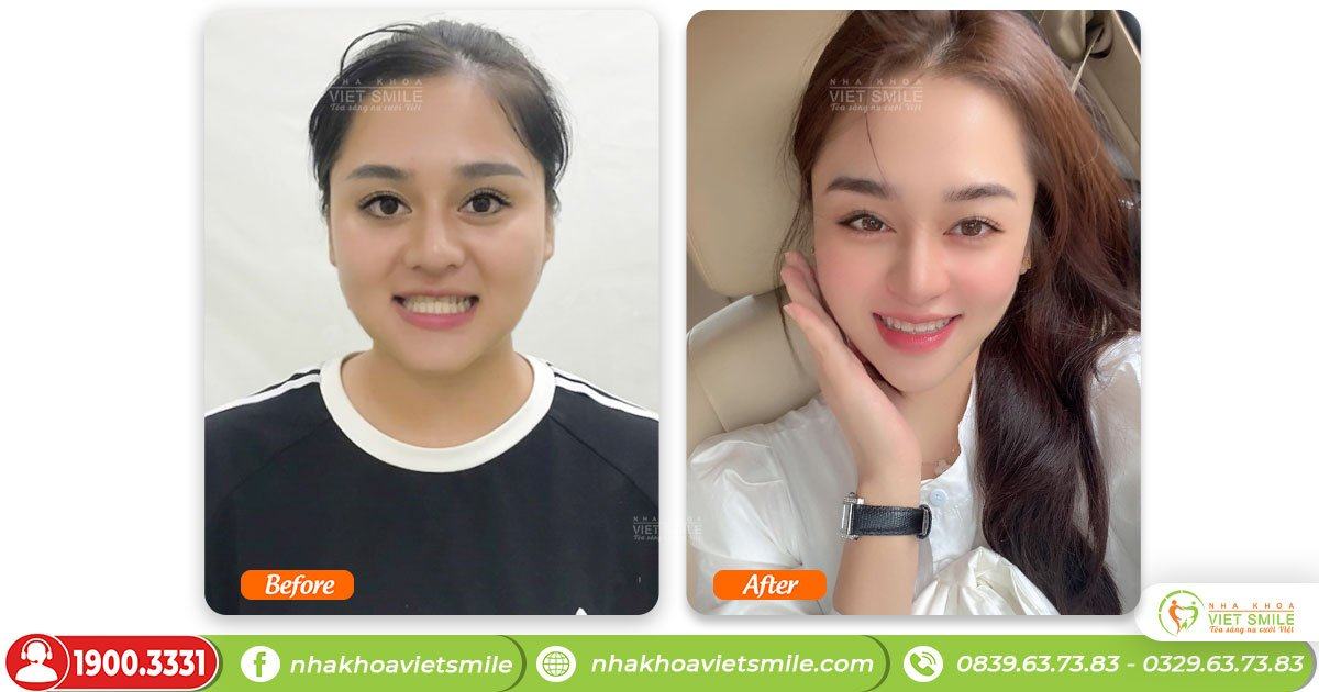 VietSmile Trị Cười Hở Lợi