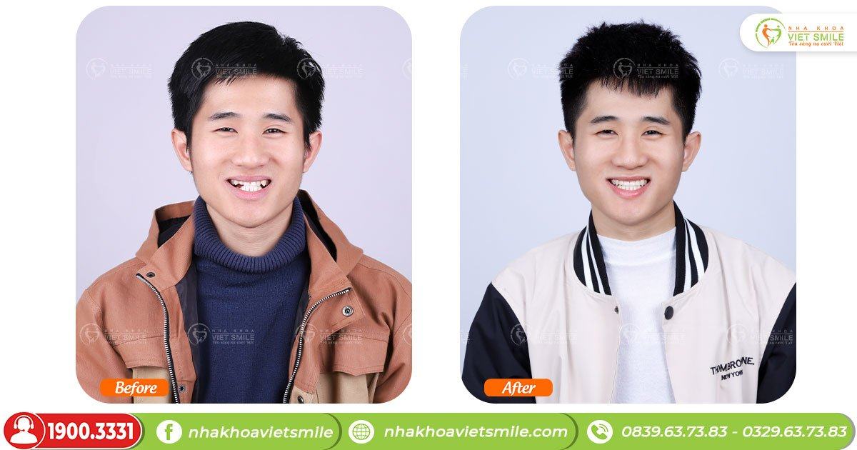 VietSmile Trị Cười Hở Lợi