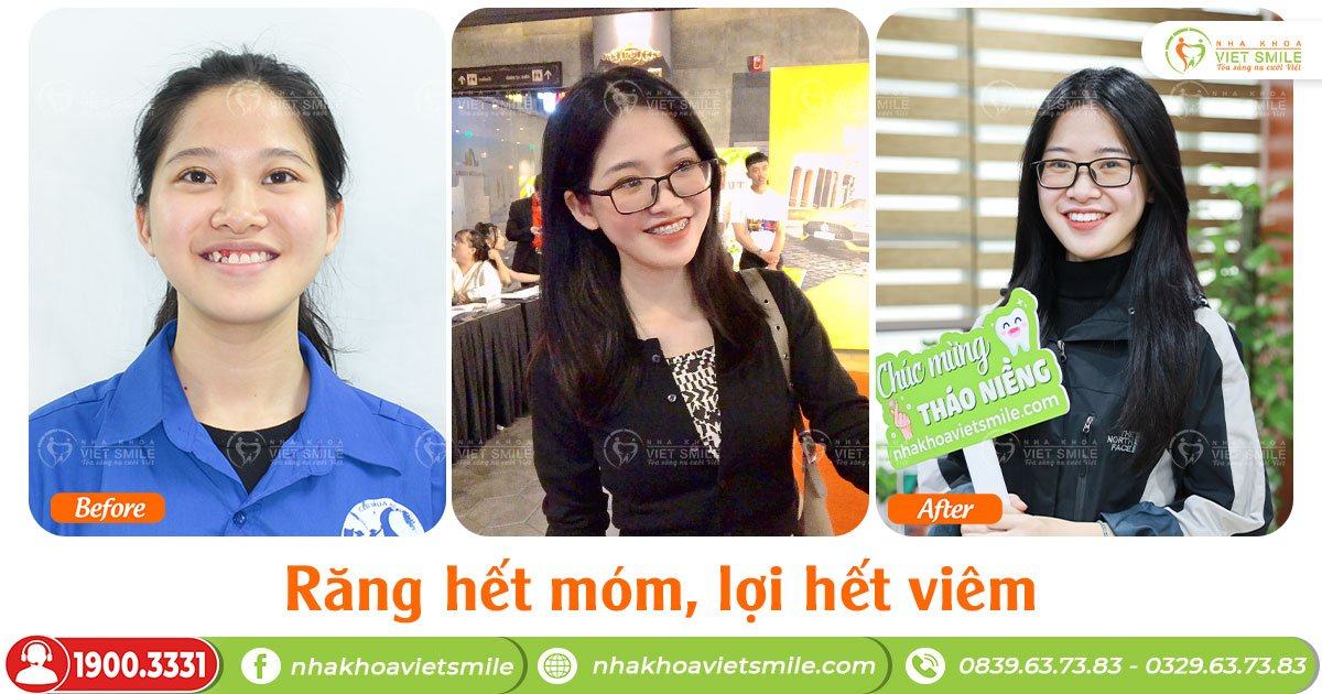 VietSmile Trị Cười Hở Lợi