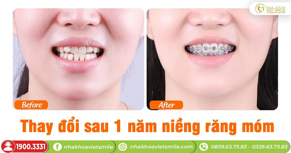 VietSmile Trị Cười Hở Lợi