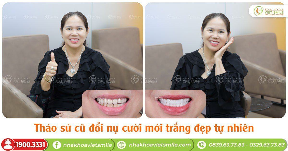 VietSmile Trị Cười Hở Lợi