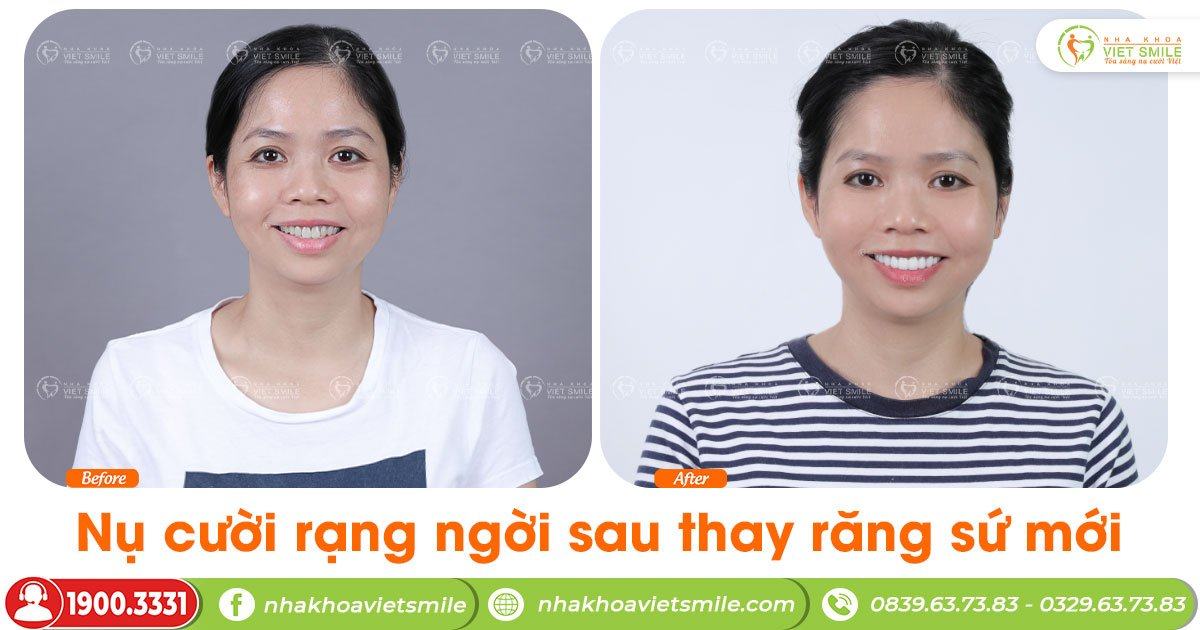 VietSmile Trị Cười Hở Lợi