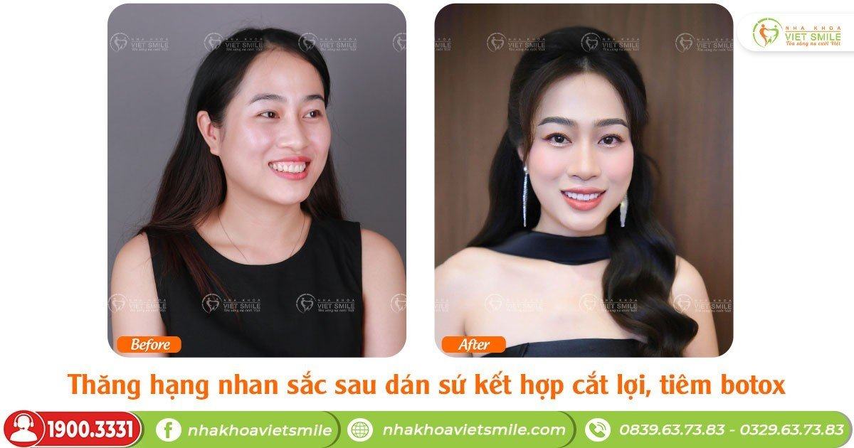 VietSmile Trị Cười Hở Lợi