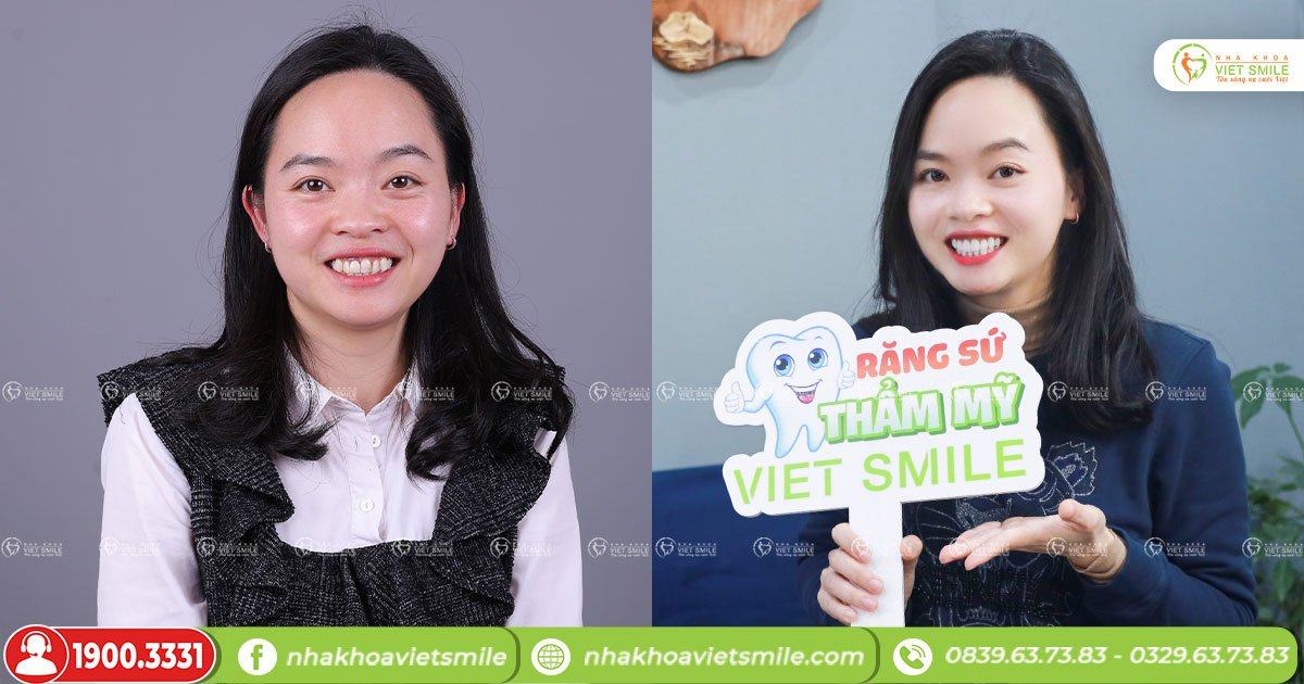 VietSmile Trị Cười Hở Lợi