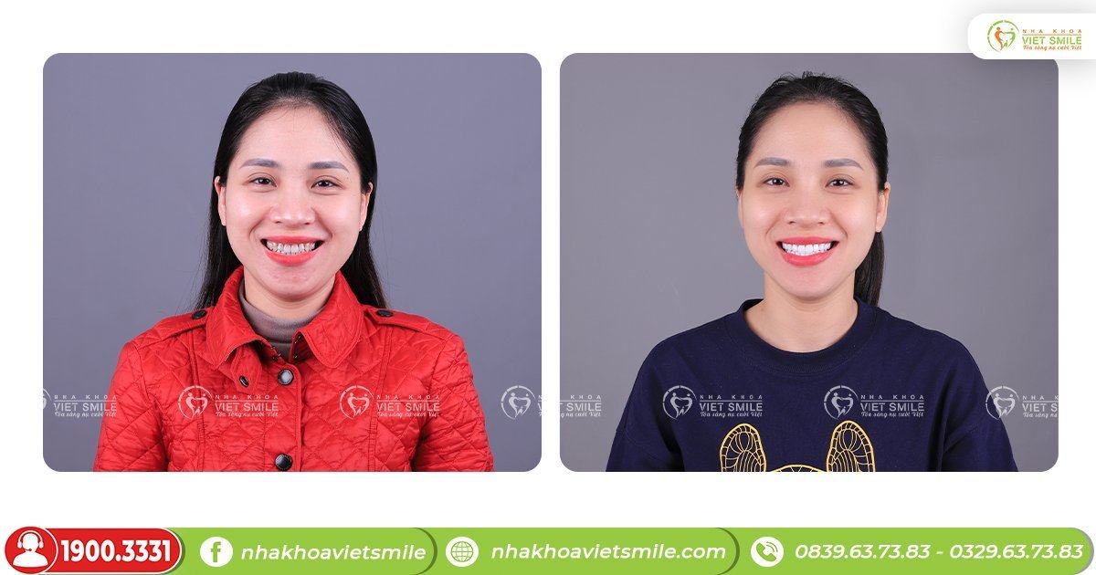 VietSmile Trị Cười Hở Lợi