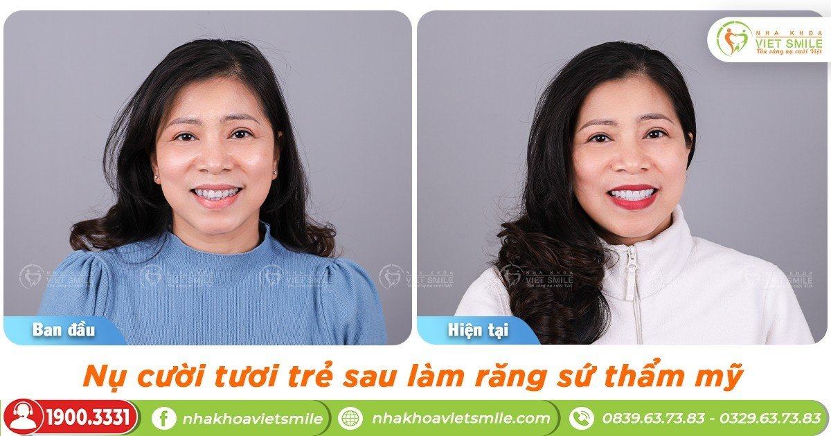 VietSmile Trị Cười Hở Lợi