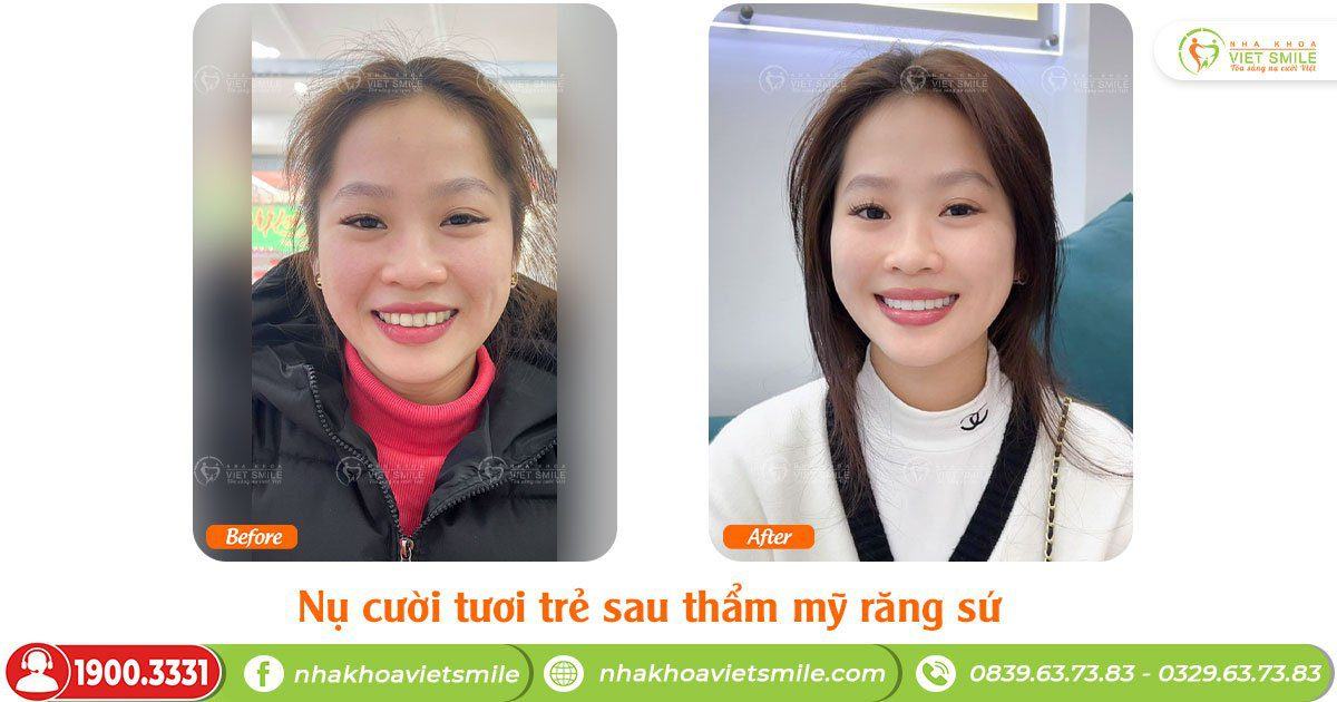 VietSmile Trị Cười Hở Lợi