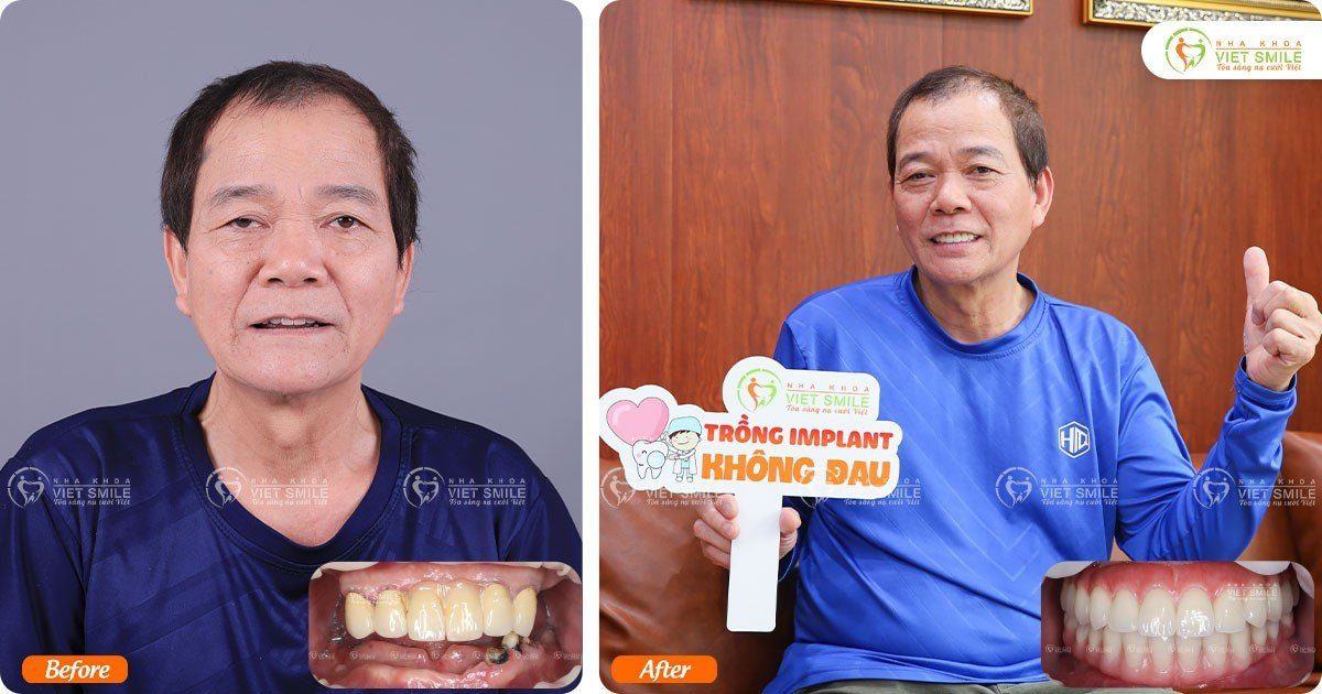 VietSmile Trị Cười Hở Lợi