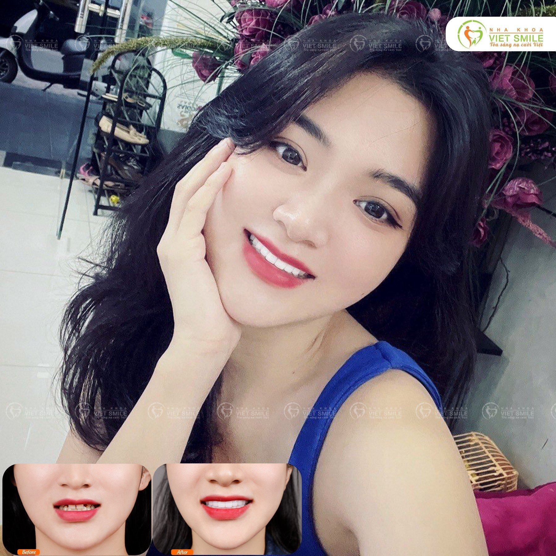 VietSmile Trị Cười Hở Lợi
