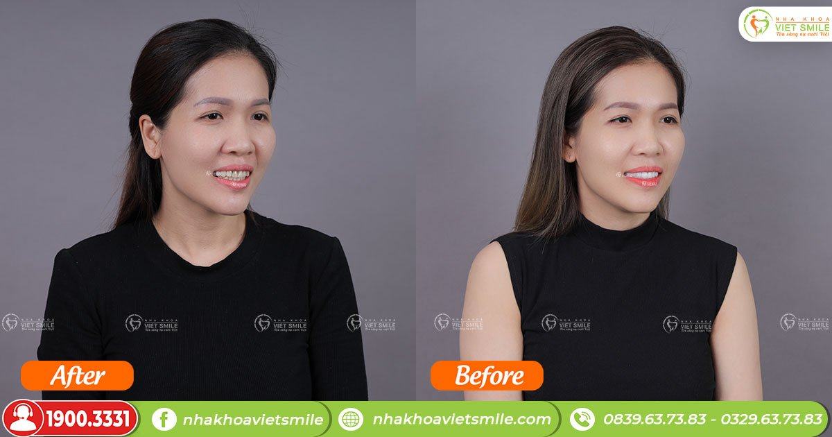 VietSmile Trị Cười Hở Lợi