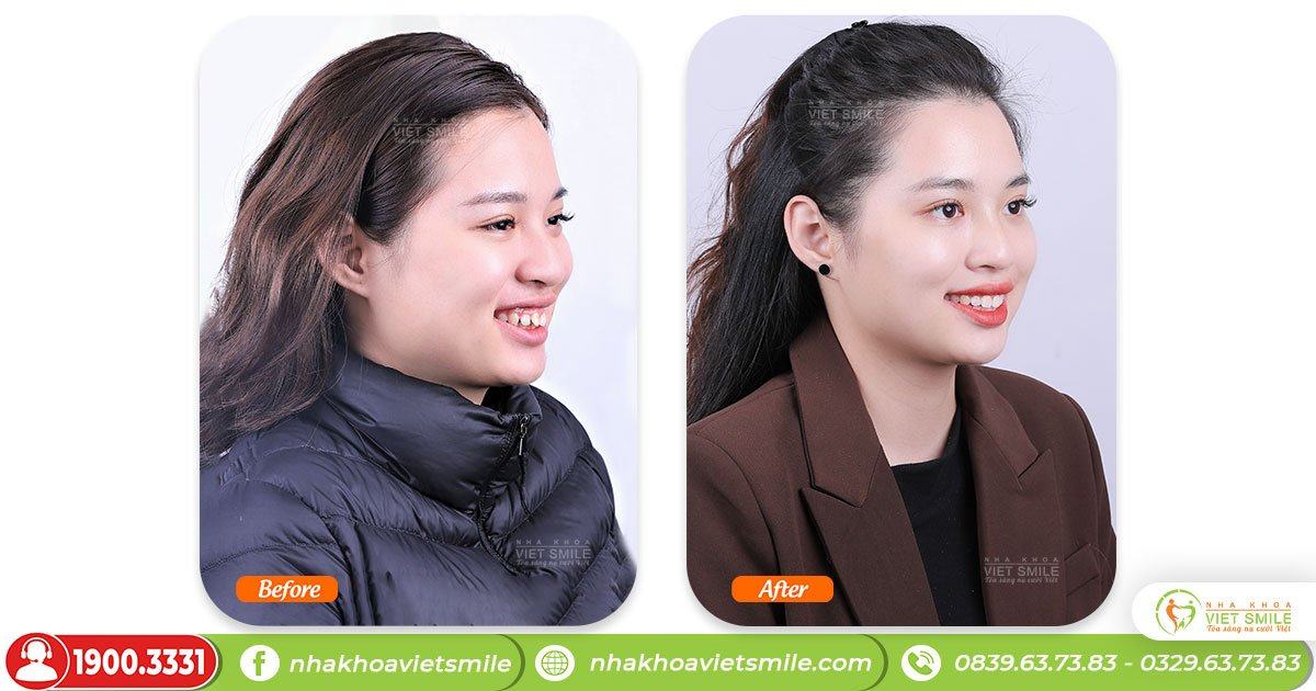 VietSmile Trị Cười Hở Lợi