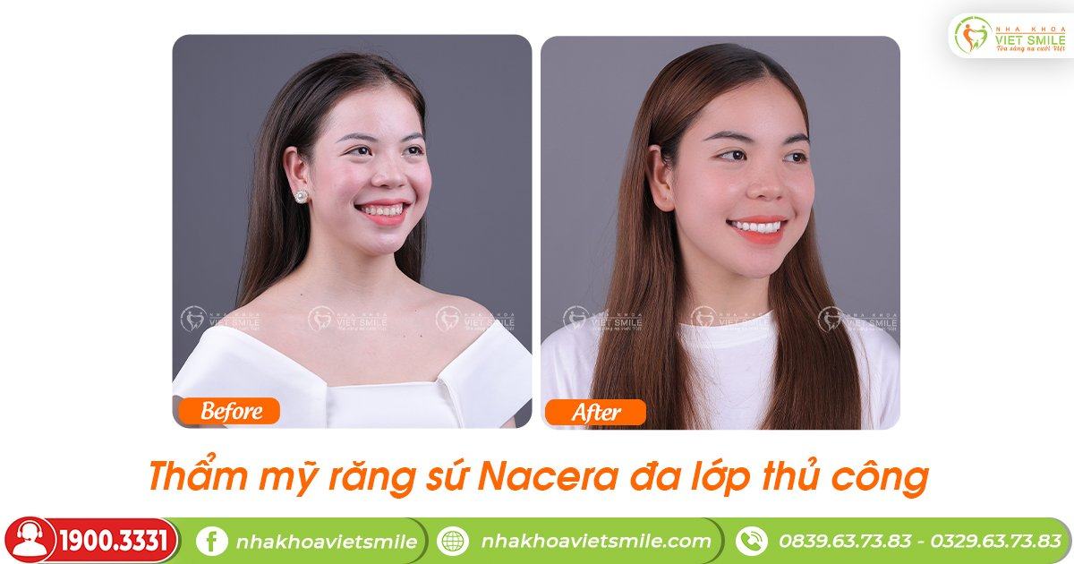 VietSmile Trị Cười Hở Lợi