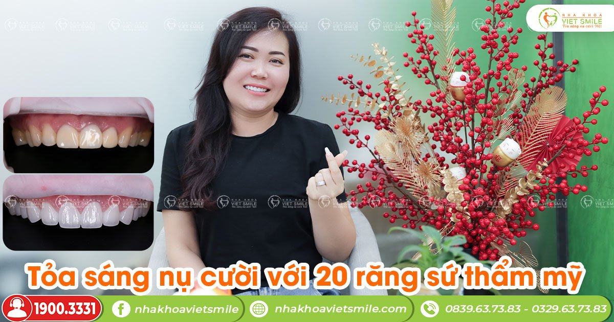 VietSmile Trị Cười Hở Lợi