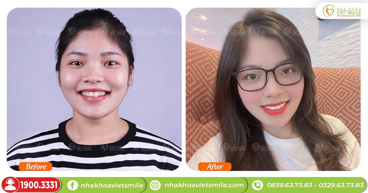 VietSmile Trị Cười Hở Lợi