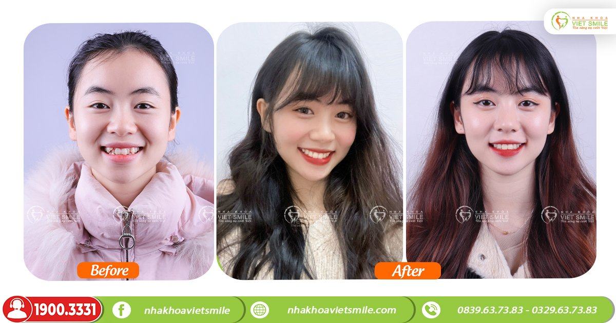 VietSmile Trị Cười Hở Lợi