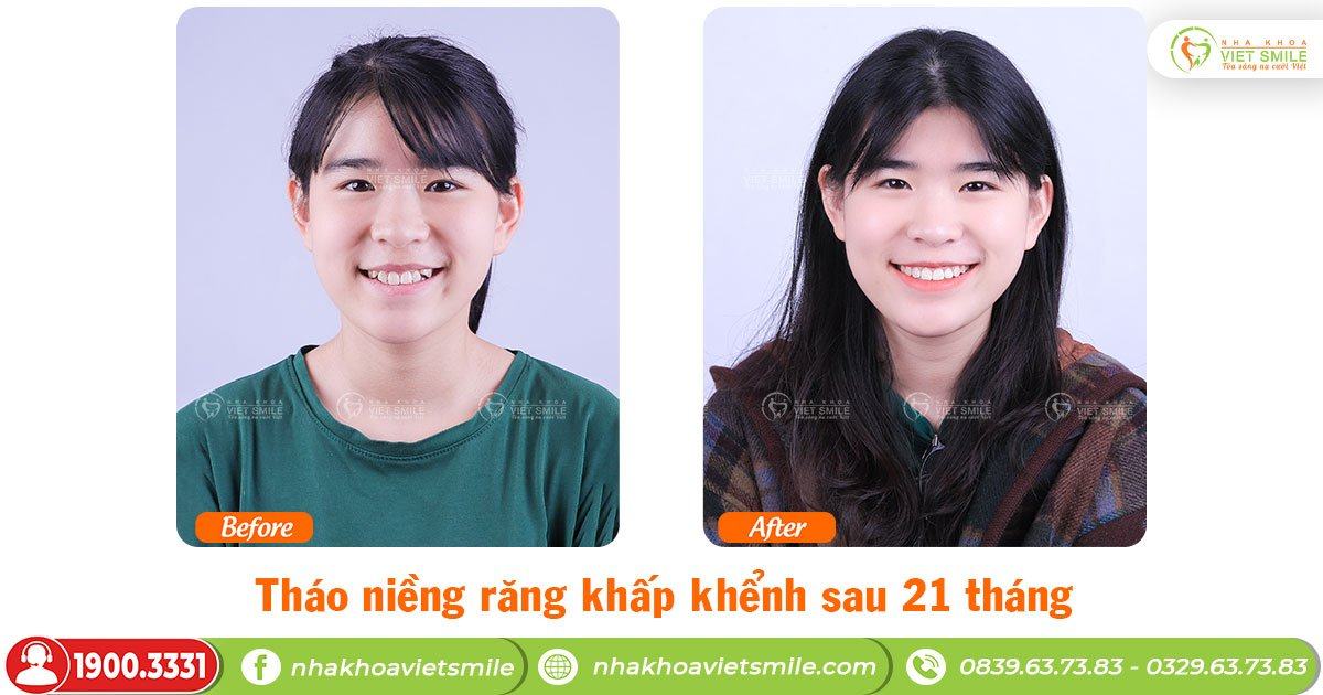 VietSmile Trị Cười Hở Lợi