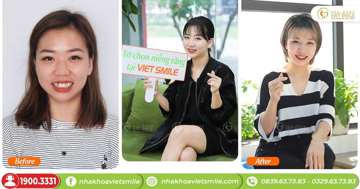 VietSmile Trị Cười Hở Lợi