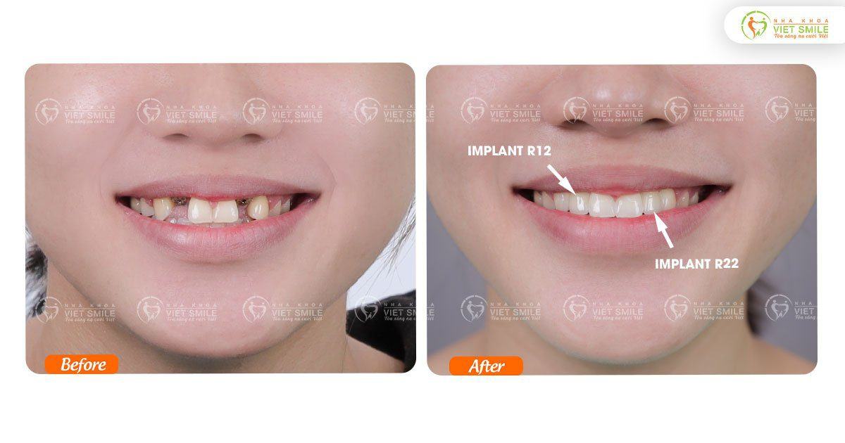 VietSmile Trị Cười Hở Lợi