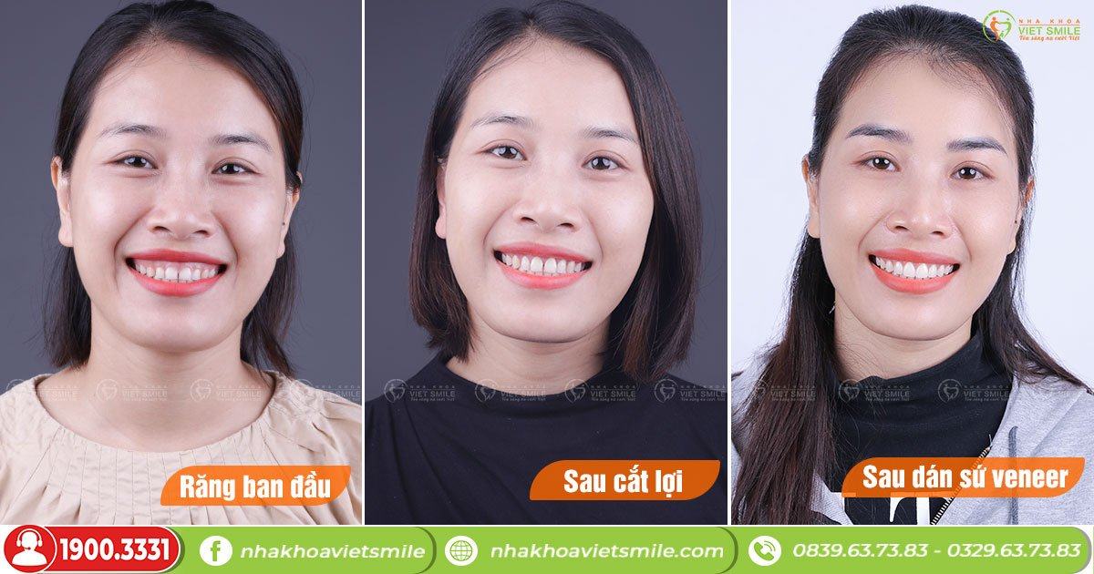 VietSmile Trị Cười Hở Lợi
