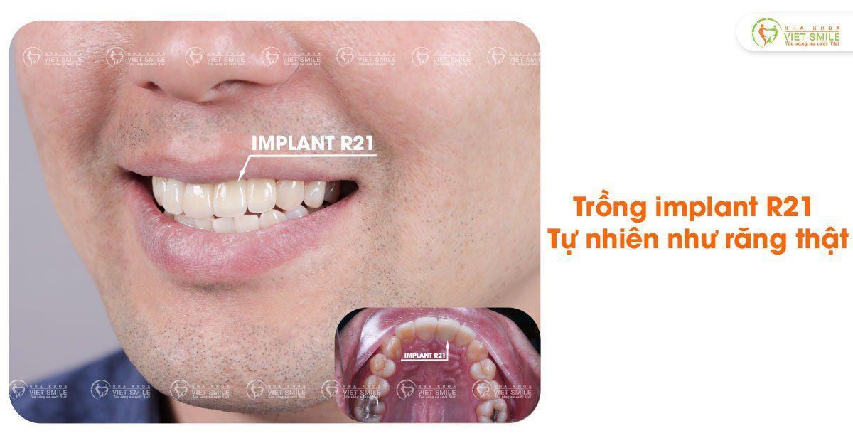 VietSmile Trị Cười Hở Lợi