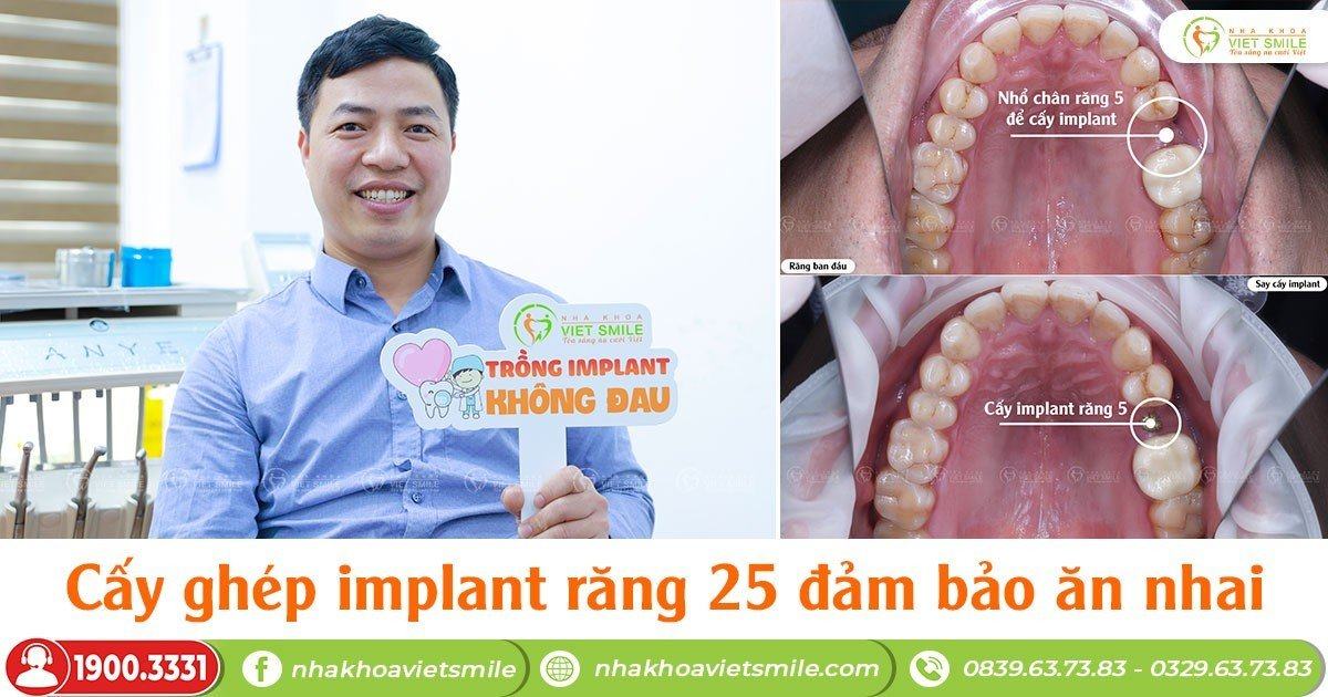 VietSmile Trị Cười Hở Lợi