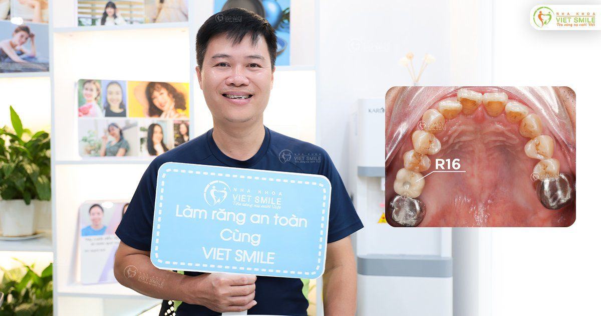 VietSmile Trị Cười Hở Lợi