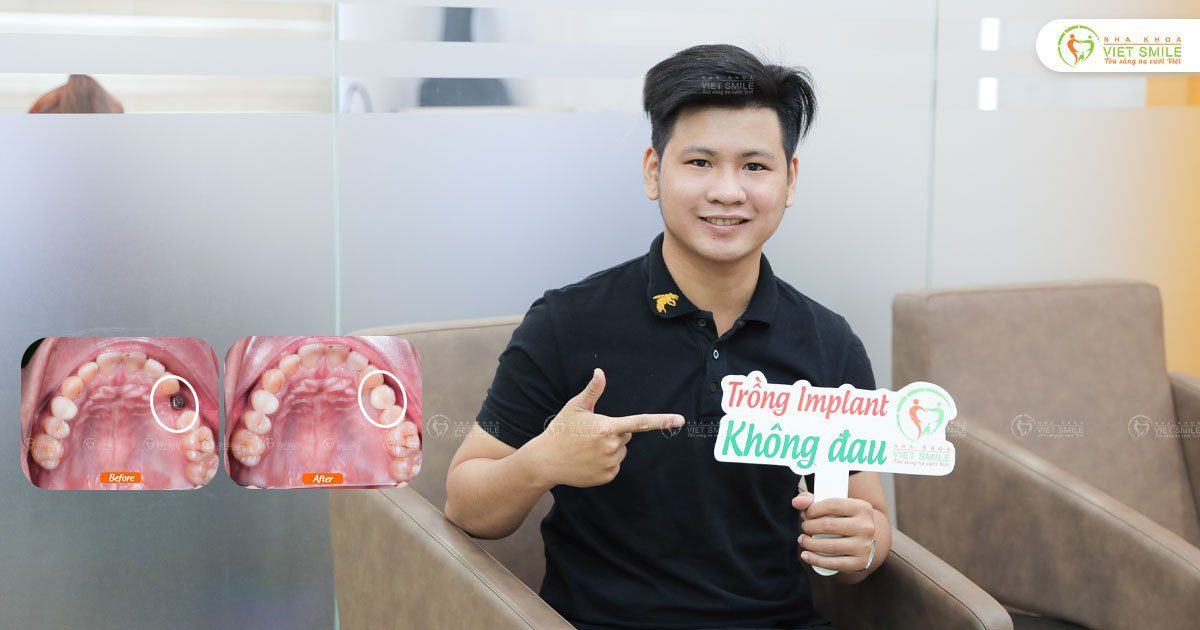 VietSmile Trị Cười Hở Lợi