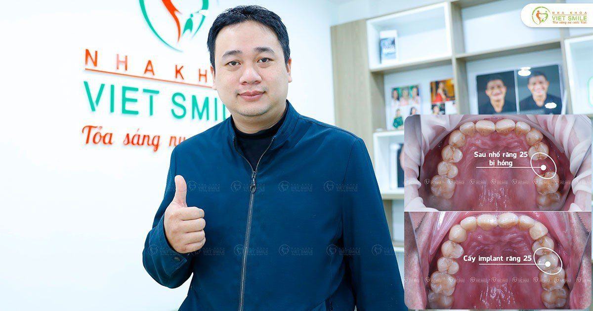 VietSmile Trị Cười Hở Lợi