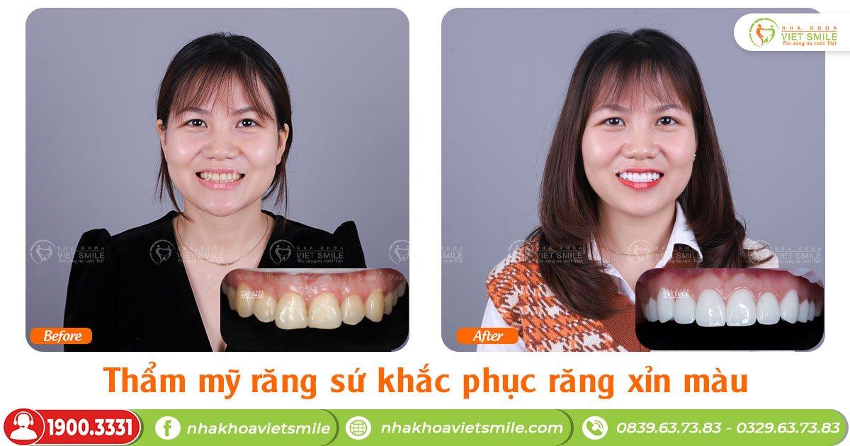 VietSmile Trị Cười Hở Lợi
