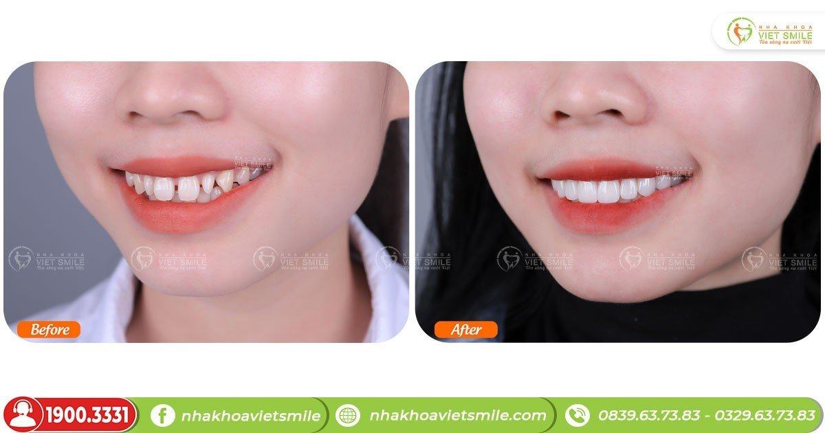 VietSmile Trị Cười Hở Lợi