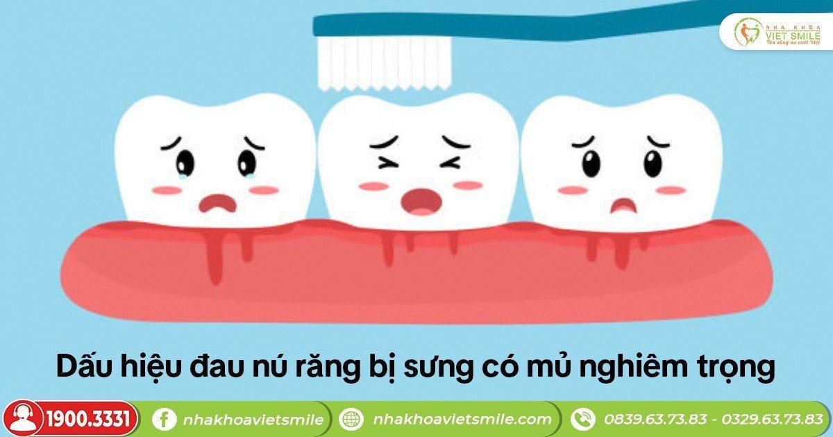 Dấu hiệu đau nú răng bị sưng có mủ nghiêm trọng
