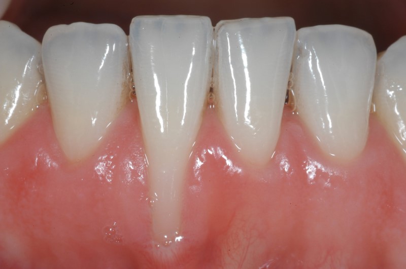 Tụt lợi răng tác động tới sức khỏe ra sao?