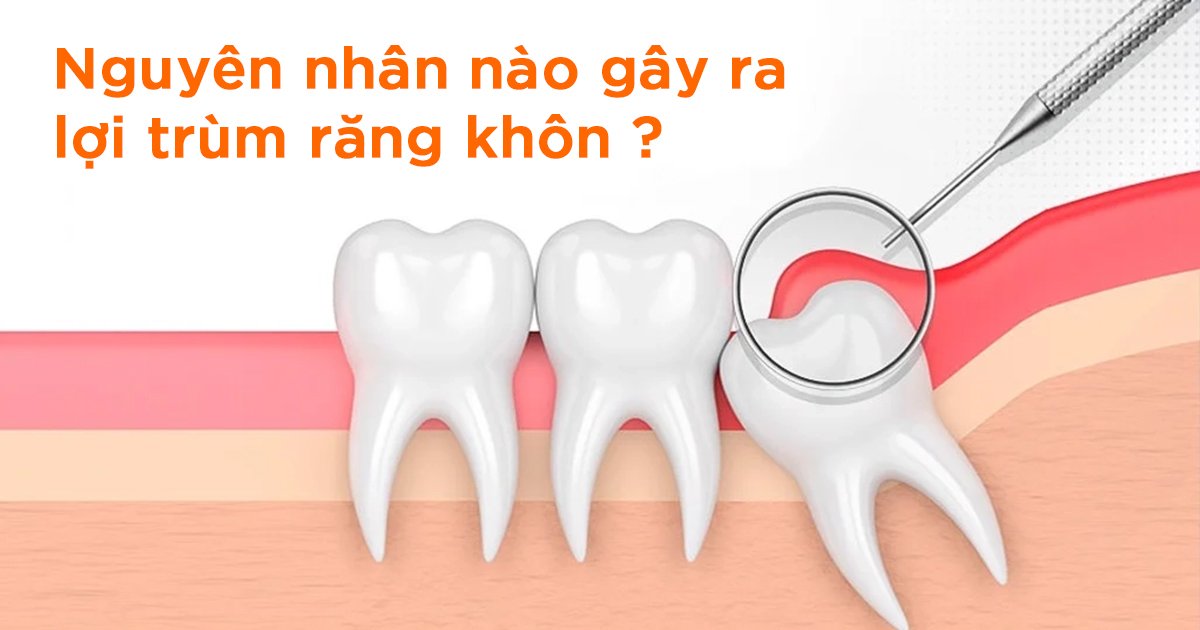 Nguyên nhân nào gây ra lợi trùm răng khôn?