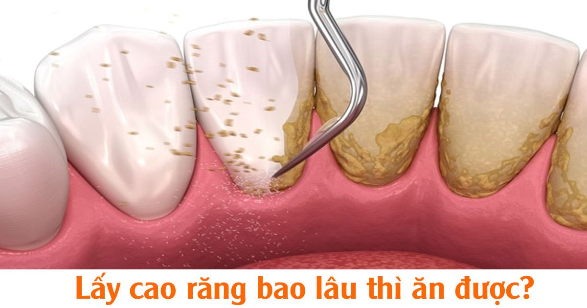 Lấy cao răng bao lâu thì ăn được?